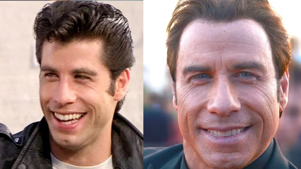 John Travolta, cirugía antes y después