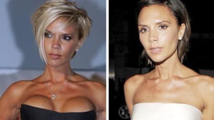 Victoria Beckham, aumento de mamas antes y después
