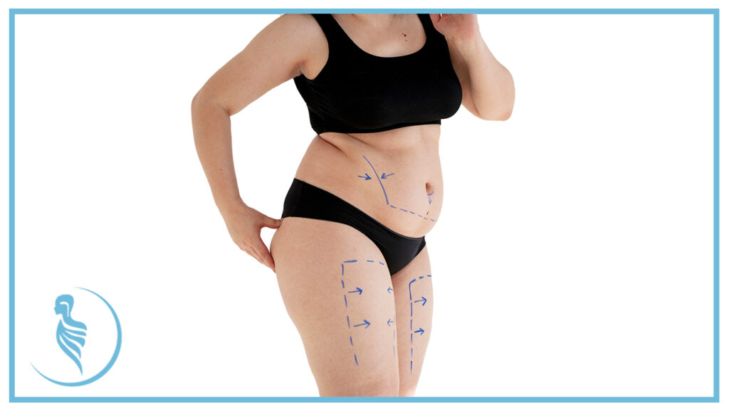 5-cirugias-esteticas-para-reducir-grasa-corporal