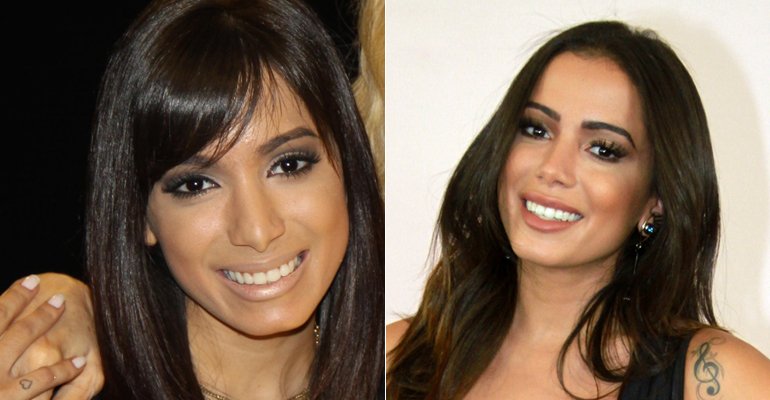 Artistas que se han realizado una Rinoplastia