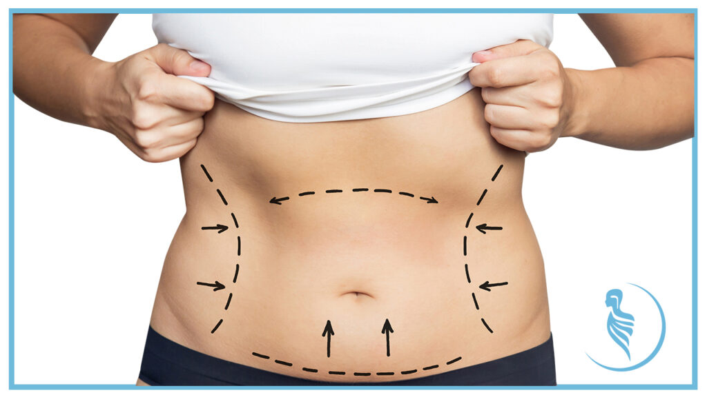 Cual-es-la-famosa-lipoescultura-360