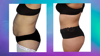 Fotos pre-operación de una Abdominoplastia