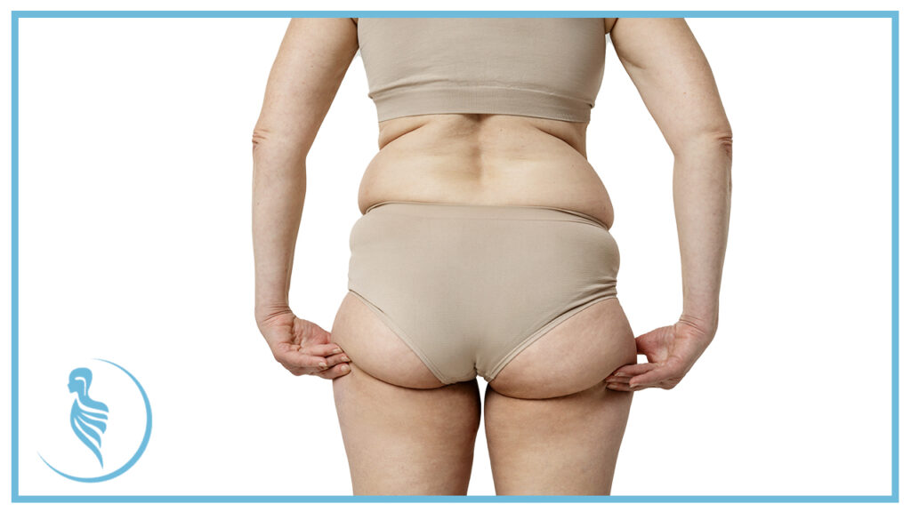 Qué es la Lipedema