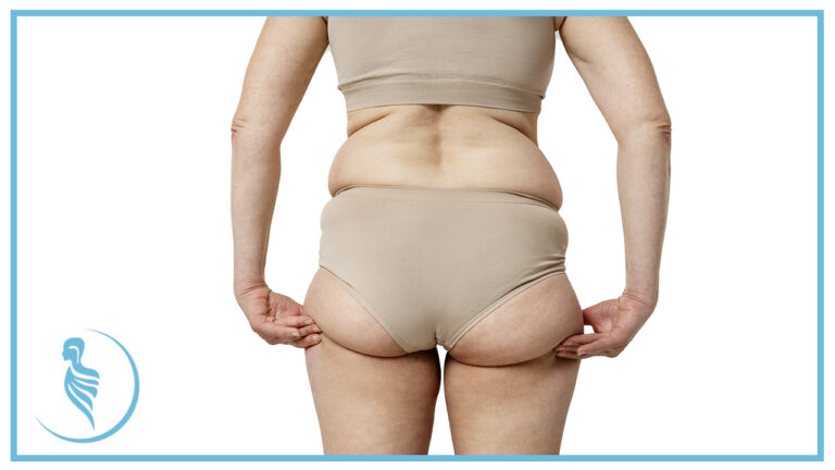 Qué es la Lipedema