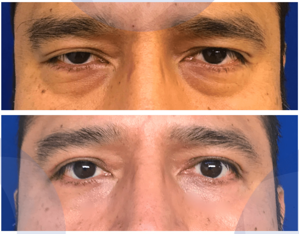 Cómo generar un cambio en tus ojos con una Blefaroplastia
