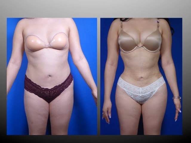 Cómo tener una cintura de avispa con liposucción