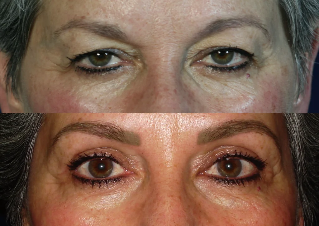 Conoce más sobre la Blefaroplastia