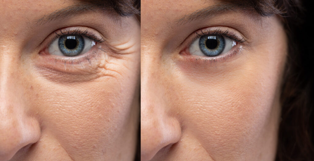 ¿Cuál es el efecto de una Blefaroplastia?