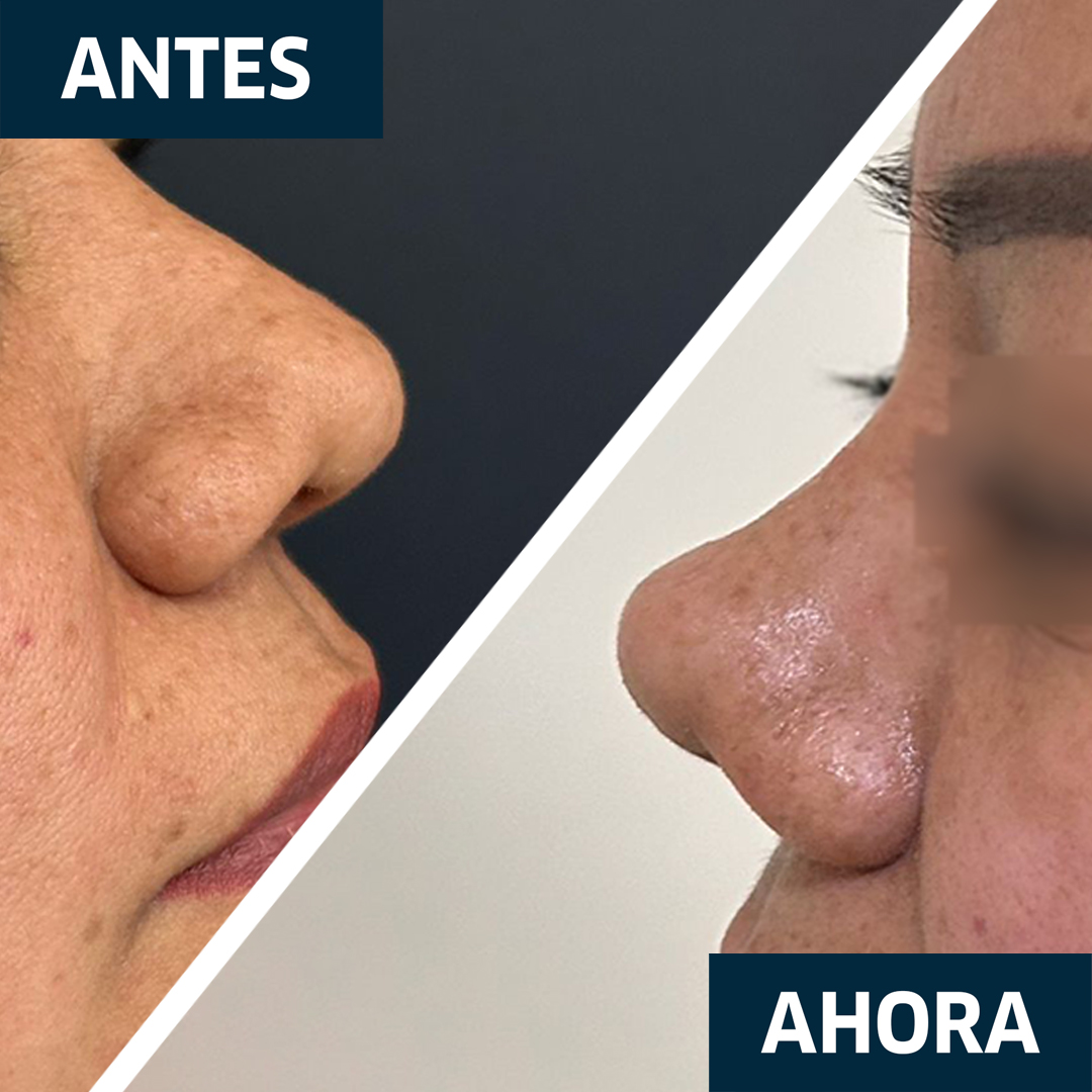 Rinoplastia Barbie Resultado 3