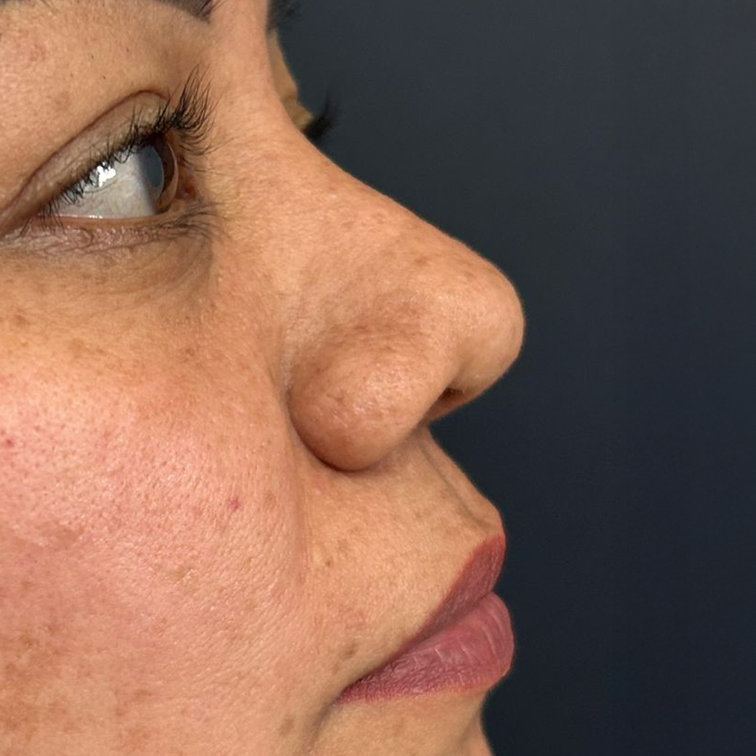 Rinoplastia Barbie Resultado 2
