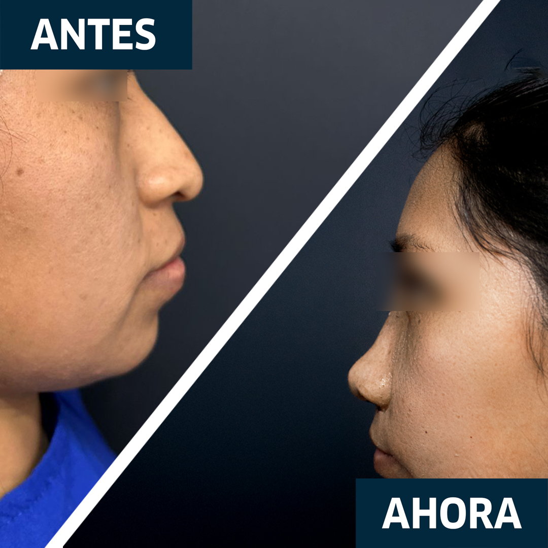 Rinoplastia Primaria Resultado 1