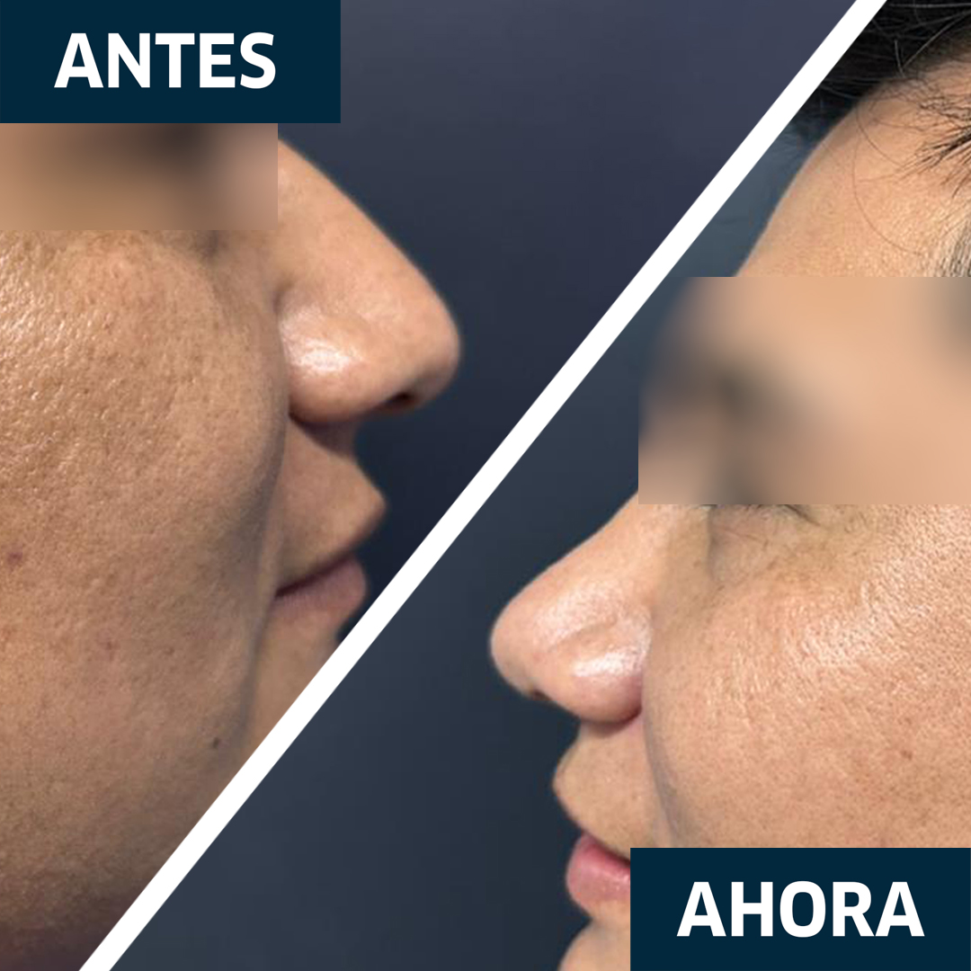 Rinoplastia Secundaria Resultado 1