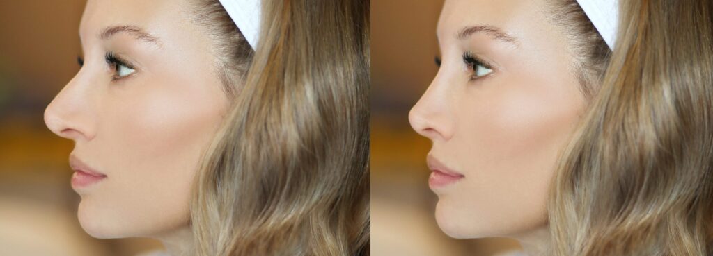 Rinoplastia ultrasónica