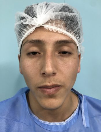 Cuál es el costo de una rinoplastia