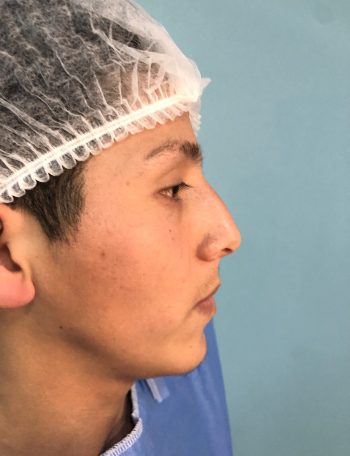 rinoplastia peru