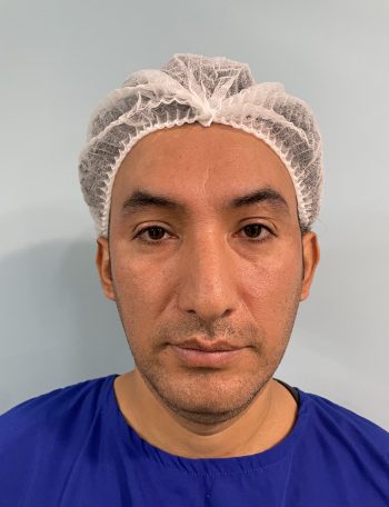 rinoplastia